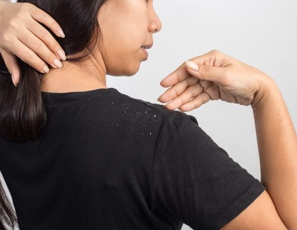 9 Easy Home Remedies for Dandruff